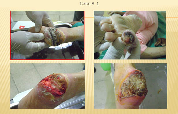 Cuidados Pie Diabetico Ecuador