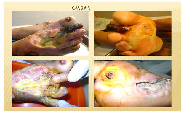 Fisiopatologia del Pie Diabetico Guayaquil