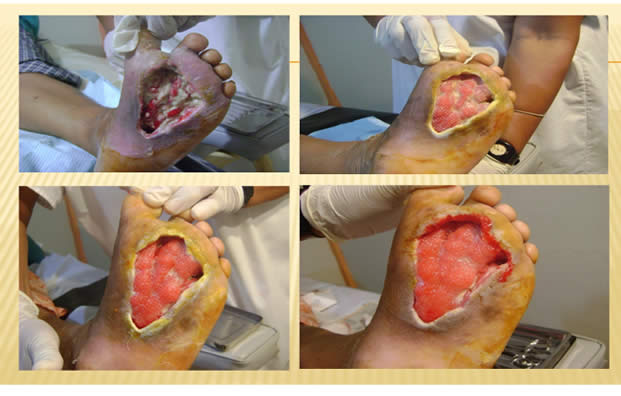 Pie Diabetico Epidemiologia Ecuador