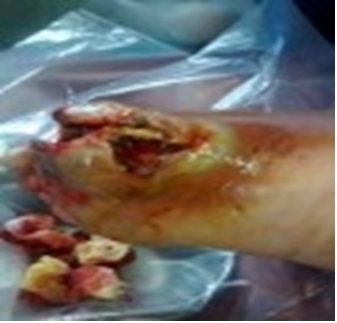 Tratamiento del Pie Diabetico