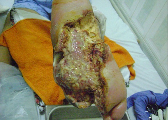 Tratamiento del Pie Diabetico