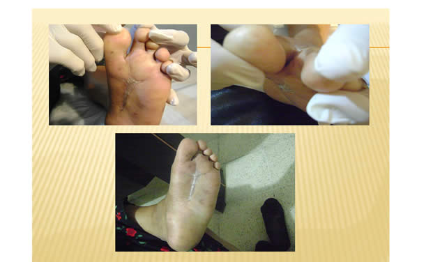 Pie Diabetico Sintomas Guayaquil