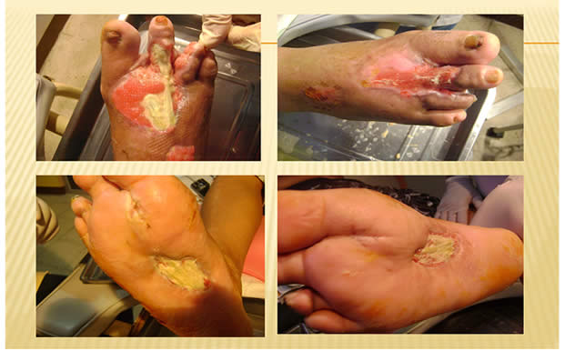Ulceras Pie Diabetico Guayaquil