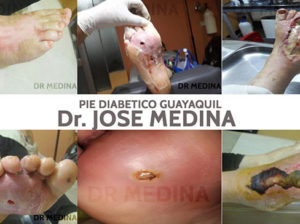 clinica del pie diabetico Dr. José Medina