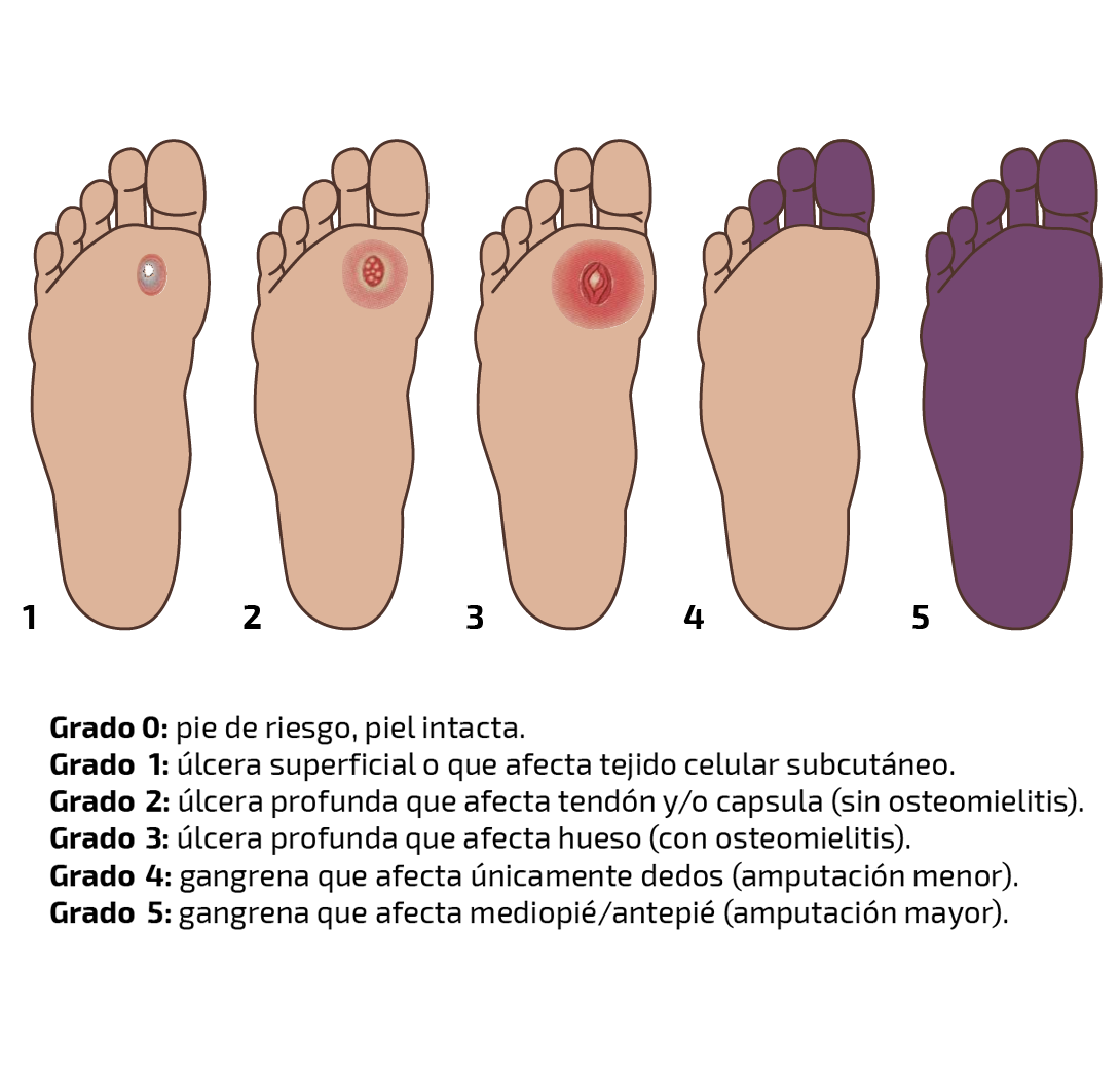 Tratamiento de úlceras diabéticas con medicina homeopática